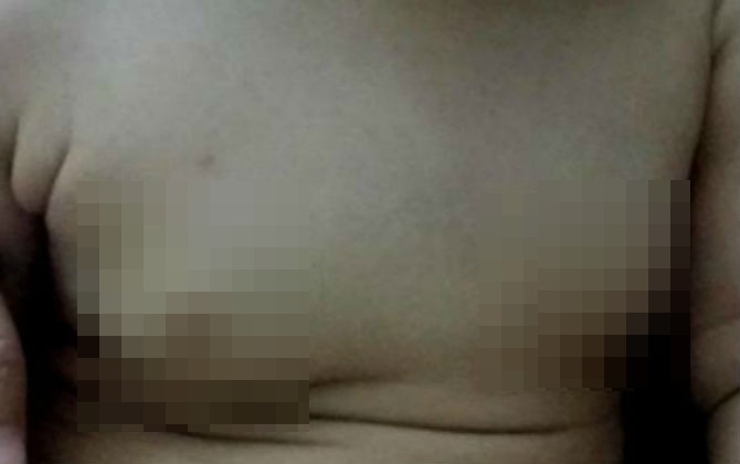 Bé gái 2 tuổi ngực phì đại do nguyên nhân không ai ngờ này