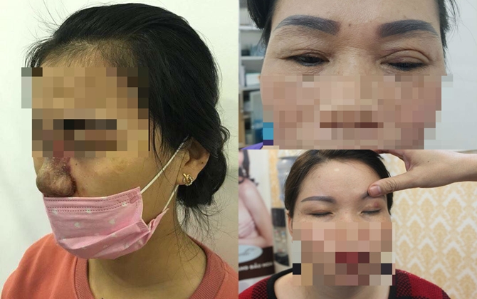 Vụ cô gái trẻ đi làm mí hỏng: Bác sĩ PTTM kể thực trạng kinh hãi khi nhấn mí luồn chỉ tại các spa không uy tín và cách 'CỨU VỚT' nhan sắc