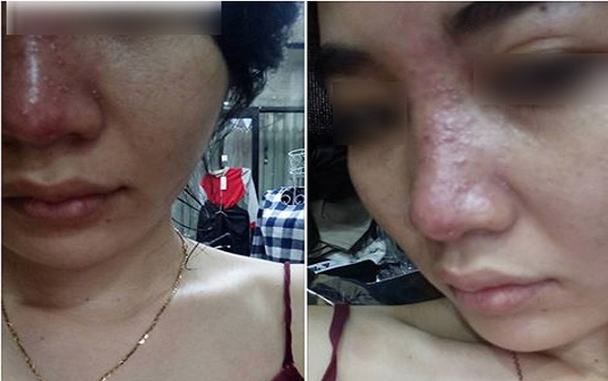 Tiêm filler nâng mũi tưởng ngon ăn, cô gái khóc thét khi biết mũi có thể hoại tử vì tiêm trúng tĩnh mạch