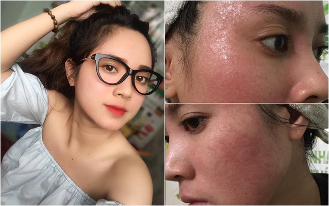 Bôi rượu thuốc bắc để "bong da tái tạo", cô gái trẻ bị nổi mụn chi chít, chảy dịch ngứa khắp mặt