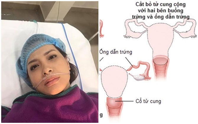 Cắt bỏ tử cung như cựu siêu mẫu Thúy Hạnh có phải nỗi đau đớn lớn nhất của người phụ nữ?