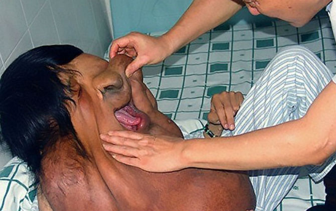 Những gương mặt chảy xệ khiến ai cũng phát hoảng nhưng nguyên nhân lại do căn bệnh cực hiếm