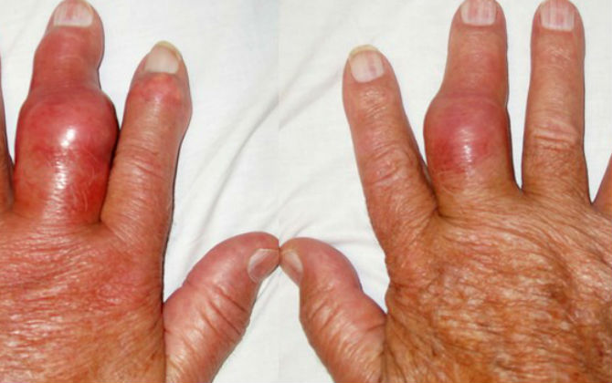 Nhiều người nghĩ ăn canh bí 3 lần/tuần chữa được gút, bác sĩ nói sự thật chắc chắn bạn không thể bỏ qua