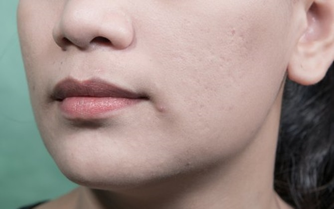 Xóa tan nỗi lo sẹo mụn với 5 phương pháp đơn giản không ngờ