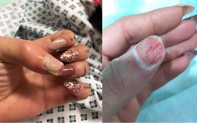 Làm nail giả đón Tết, cẩn thận hoại tử và suýt mất đi ngón tay cái như người phụ nữ này