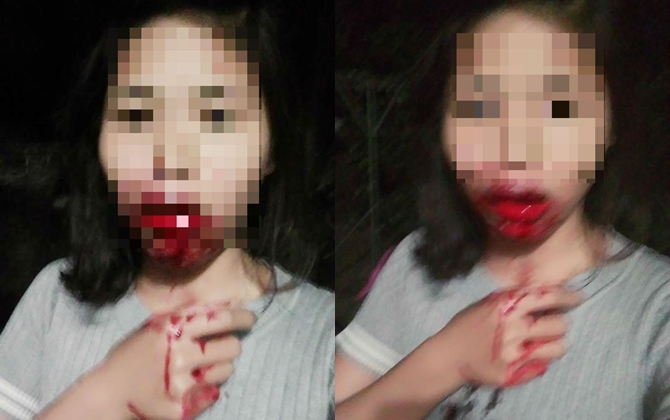Phẫn nộ với ông chồng đánh vợ hộc háu miệng chỉ vì nửa đêm bị vợ gọi dậy đưa đi vệ sinh