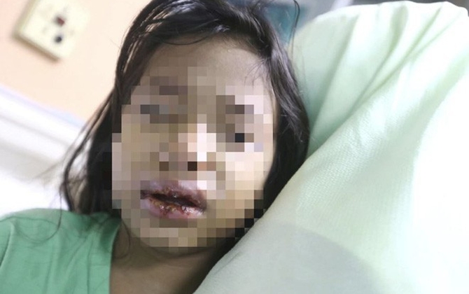 Đến đón con ở nhà chồng cũ, mẹ đau đớn phát hiện con bị mẹ kế bạo hành ép uống nước sôi