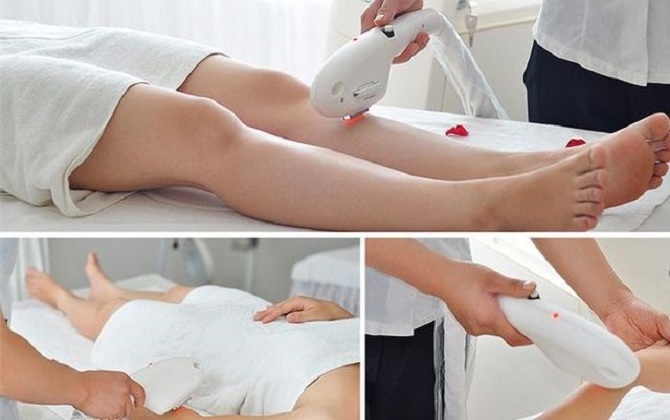 Triệt lông vĩnh viễn bằng laser đang khiến chị em phát sốt nhưng hãy chú ý những điều sau