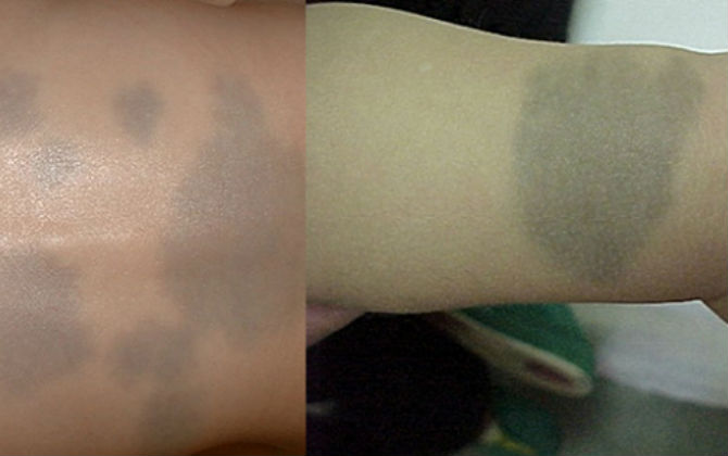 Vết bớt xanh trên người trẻ tưởng đơn giản nhưng sự thật là....