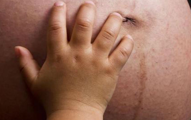 3 lý do mẹ bầu đừng vội ghét đường sọc nâu giữa bụng