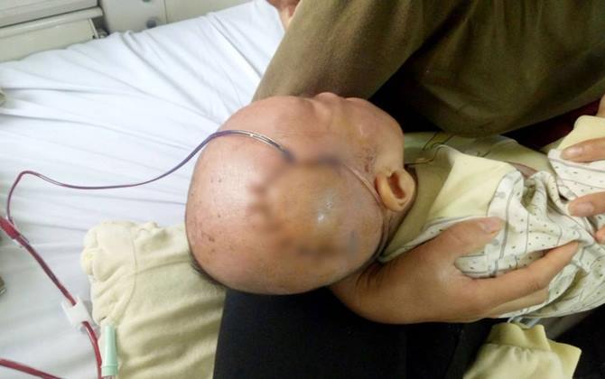Thương tâm: Bé trai 9 tháng tuổi bị lún sọ não vì ngã từ trên giường bệnh xuống đất