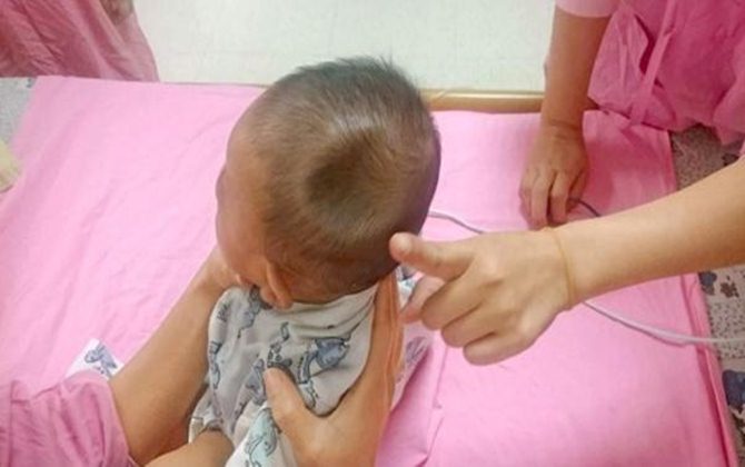 Bé 4 tháng ĐẦU LÕM SÂU như quả táo cắn dở do sai lầm này của mẹ