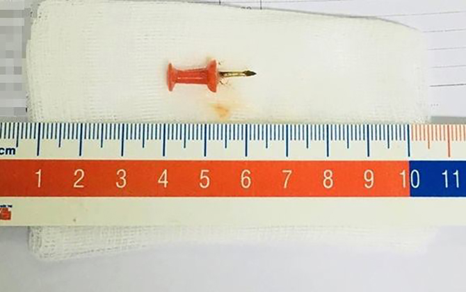 Trẻ bị hóc hạt ngô và đinh ghim giấy được cứu sống
