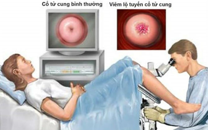 Đốt viêm lộ tuyến cổ tử cung có ảnh hưởng đến chức năng sinh sản như chị em đang nghĩ