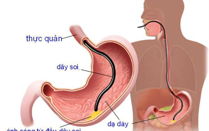 Nếu trẻ xuất hiện tình trạng đau bụng thường xuyên, buồn nôn, ăn uống kém cẩn thận mắc căn bệnh đáng sợ này