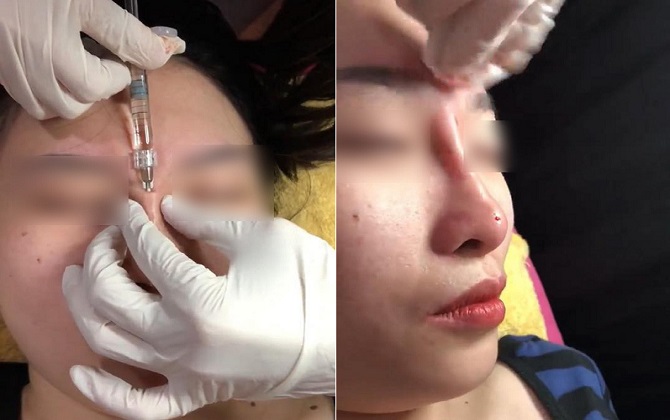 Vừa tiêm filler vừa nặn sống mũi - nhìn qua thôi cũng thấy đau đớn thay cho người bị tiêm