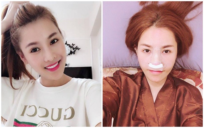 Thấy Song Hye Kyo quá đẹp, Quế Vân chi 200 triệu sang Hàn sửa mũi lần thứ 6 để giống thần tượng