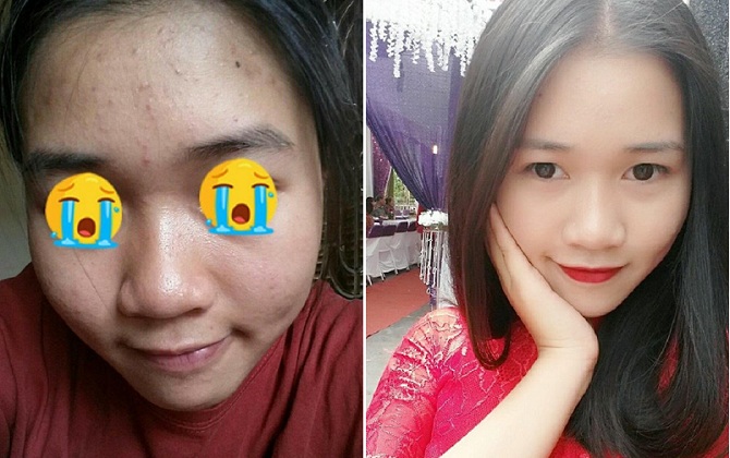 Bị mụn dày mặt cô gái 9X lấy cà rốt làm điều này và bất ngờ 'lột xác' với làn da không tỳ vết