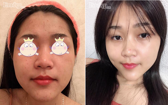 Mụn ‘cứng đầu’ đến mấy cũng hết ‘sạch sành sanh’ nhờ nguyên liệu nhà nào cũng có