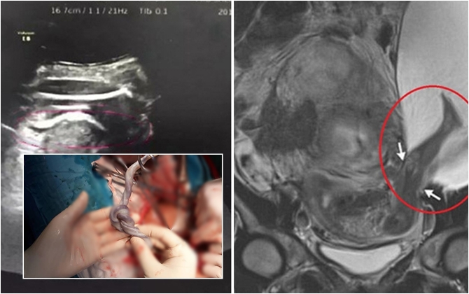 Mẹ bầu đau dữ dội, phải mổ gấp vì thai nhi đạp thủng tử cung