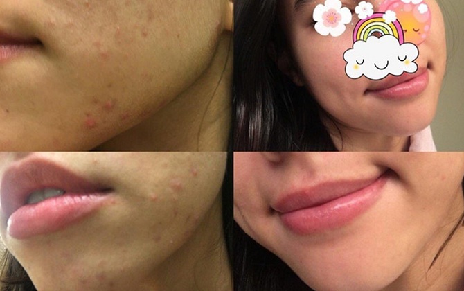 Mụn li ti sần sùi trên mặt sẽ biến hết trong 1 nốt nhạc nhờ các bước chăm sóc này
