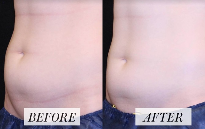 Sau 15 phút áp dụng, mỡ bụng cứng đầu đã bay biến với phương pháp thẩm mỹ mới nhất này