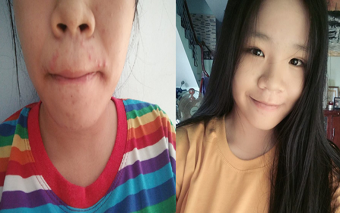 4 lần/1 tuần đắp loại mặt nạ tự nhiên này, nàng 9X quét sạch mụn trứng cá, da mịn màng không tỳ vết