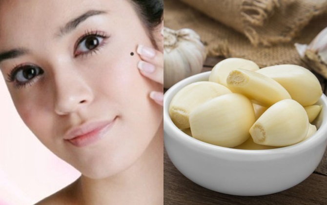 Không phải tốn tiền đi spa làm gì, chỉ cần dùng tỏi là xóa bay các nốt ruồi cứng đầu