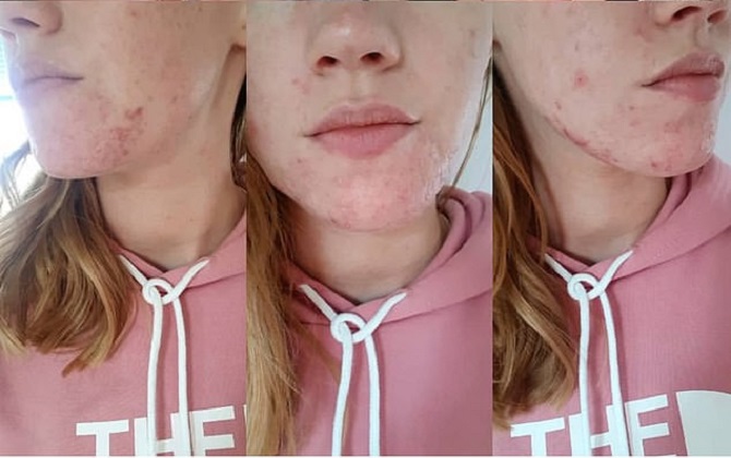 Bánh xà phòng "tầm thường" chưa đến 200 nghìn mà diệt tận gốc đám mụn xấu xí