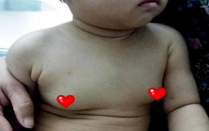 Con trai 12 tuổi ngực to như quả cam, bác sĩ: "Bị nữ tính hoá vì sai lầm của mẹ"