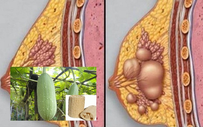Muốn chữa dứt điểm tắc tia sữa sau sinh, mẹ phải nhớ ngay nguyên liệu nhà bếp này