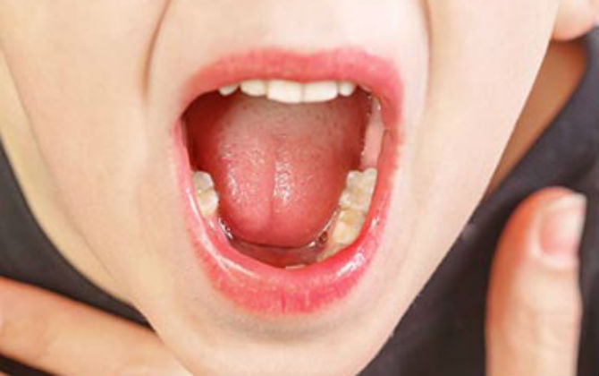 Nhiều cha mẹ nghĩ cắt amidan là tốt cho con, nhưng sự thật này không phải ai cũng biết