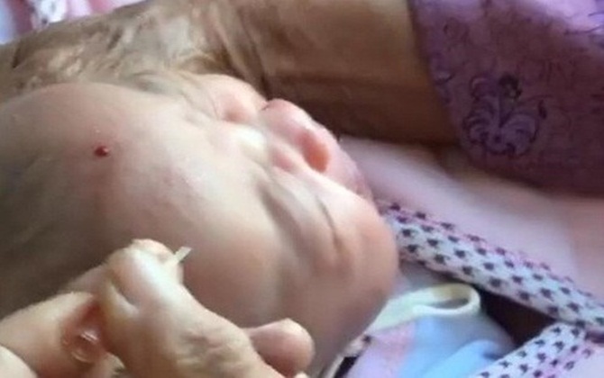 Choáng với phương pháp lấy kim chích nặn máu độc để trẻ "hay ăn chóng lớn"