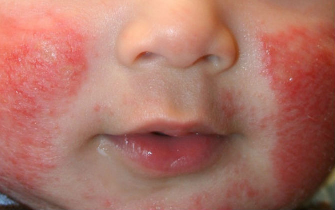 Ngoài lây Herpes, ôm hôn trẻ còn có thể gây nên bệnh ngoài da đáng sợ này cực kỳ dễ gặp vào mùa đông