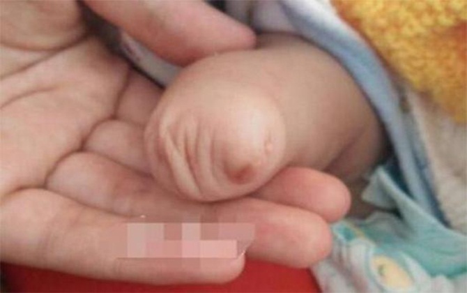 Mẹ xót lòng nhìn con sinh ra không có bàn tay vì lỡ làm "việc cấm" lúc cấn thai