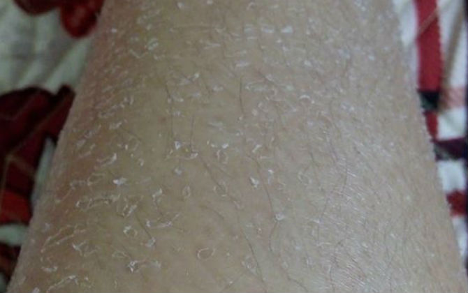 Cô gái than thở vấn đề ở da mà nhiều người mắc, trời càng lạnh càng đáng sợ, nhưng có ai biết những lưu ý này để khắc phục?