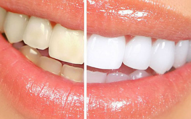 Năm mới nếu muốn làm trăng hàm răng nhất định phải biết những điều sau đây