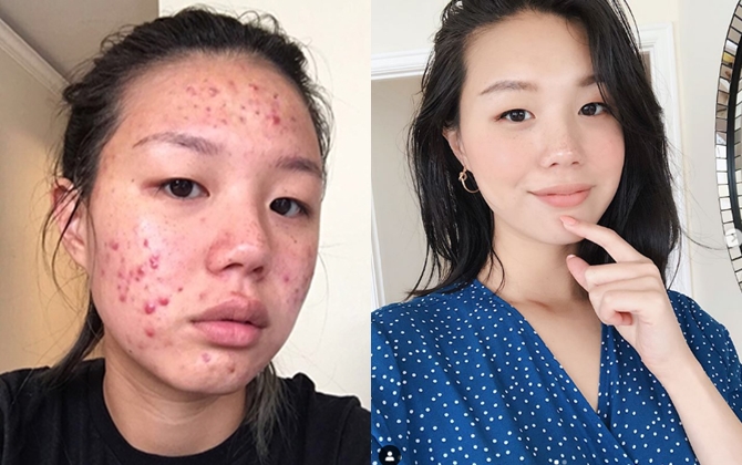 Khủng hoảng vì mụn chi chít như tổ ong, beauty blogger nổi tiếng Hàn Quốc đã tìm lại làn da thủy tinh trong vắt nhờ cách này