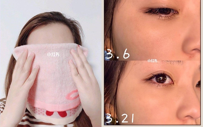 Thấy lỗ chân lông to, chị em ồ ạt đi phi kim tốn kém mà chẳng hay chỉ cần dùng khăn nóng thế này là se khít, láng mịn
