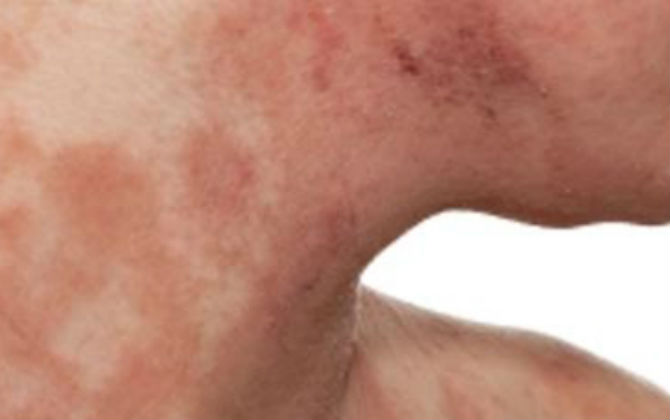 Nhiều người nghĩ viêm da cơ địa chữa dễ dàng và dùng lá là xong nhưng đây mới là sự thật