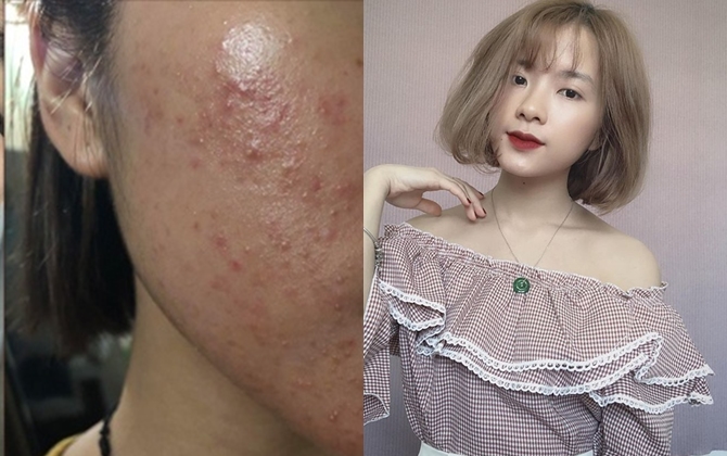 9X Sài Gòn tiết lộ kinh nghiệm trị sạch mụn sau 5 tháng