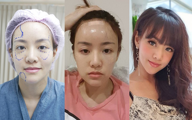 Ca sỹ người Thái lột xác ngoạn mục sau khi quyết định tiêm mỡ tự thân, trẻ hóa khuôn mặt