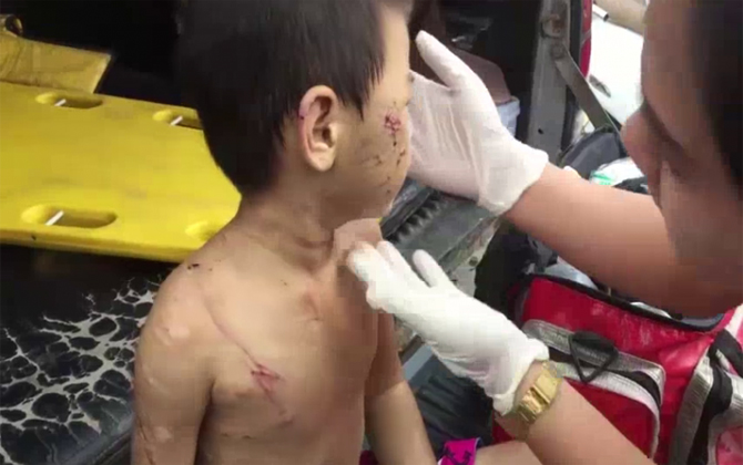 Xót thương cậu bé 6 tuổi bị mẹ ruột, cha dượng đánh đập dã man bầm tím khắp cơ thể