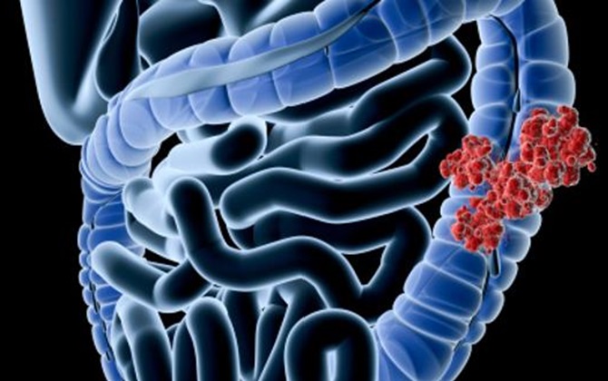 Muốn ngăn chặn polyp đại tràng nguy hiểm, bạn hãy nhớ 6 lời khuyên này