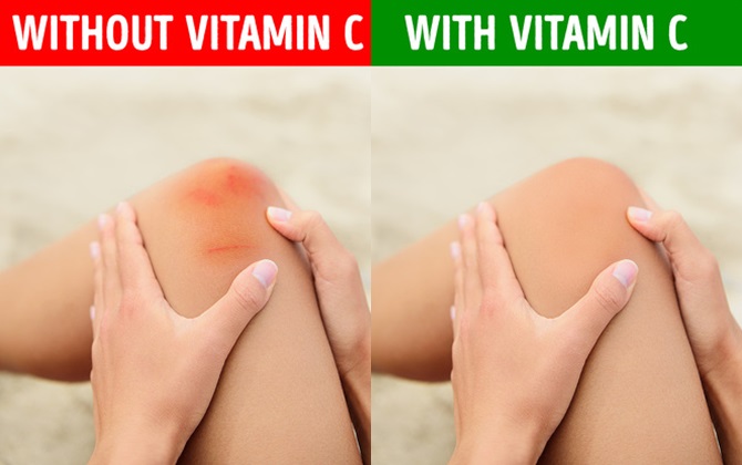 Chỉ cần để ý 10 dấu hiệu này thôi là cơ thể đang thiếu vitamin C nghiêm trọng