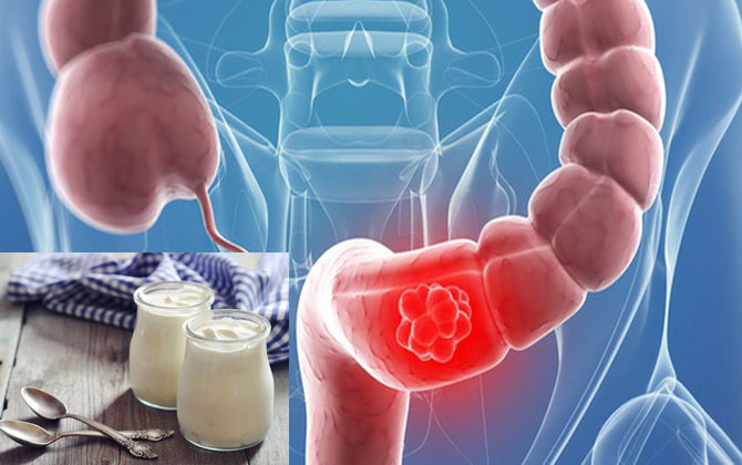 Ăn món này hàng ngày giúp giảm 26% nguy cơ mắc bệnh ung thư đại trực tràng