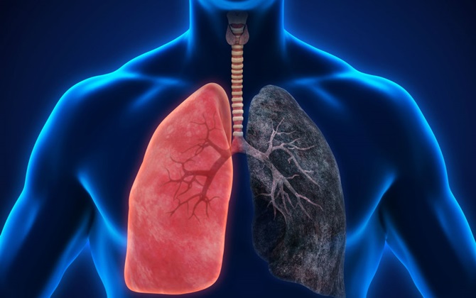Dấu hiệu cảnh báo đã bị ung thư phổi, nhiều người không ngờ đến