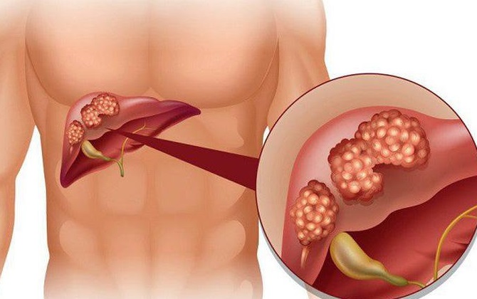 Nhiều người bị gan nhiễm mỡ nhưng không hề biết chúng chuyển thành ung thư chỉ qua 4 giai đoạn này