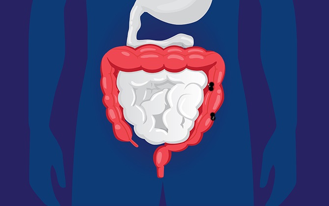 Có phải người sau 40 tuổi mới dễ mắc ung thư đại tràng?