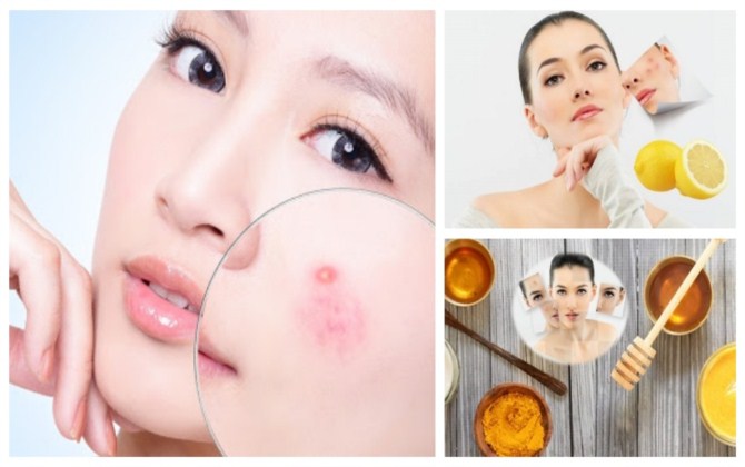 Mất tiền triệu đến spa cũng chưa chắc đã trị mụn hiệu quả bằng những công thức mặt nạ tự nhiên làm tại nhà này